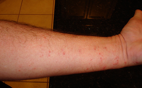 Skin Irritation On Arm Pictures Photos